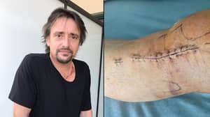 理查德·哈蒙德展示了他在“大旅行”事故中拍的x光片和伤疤