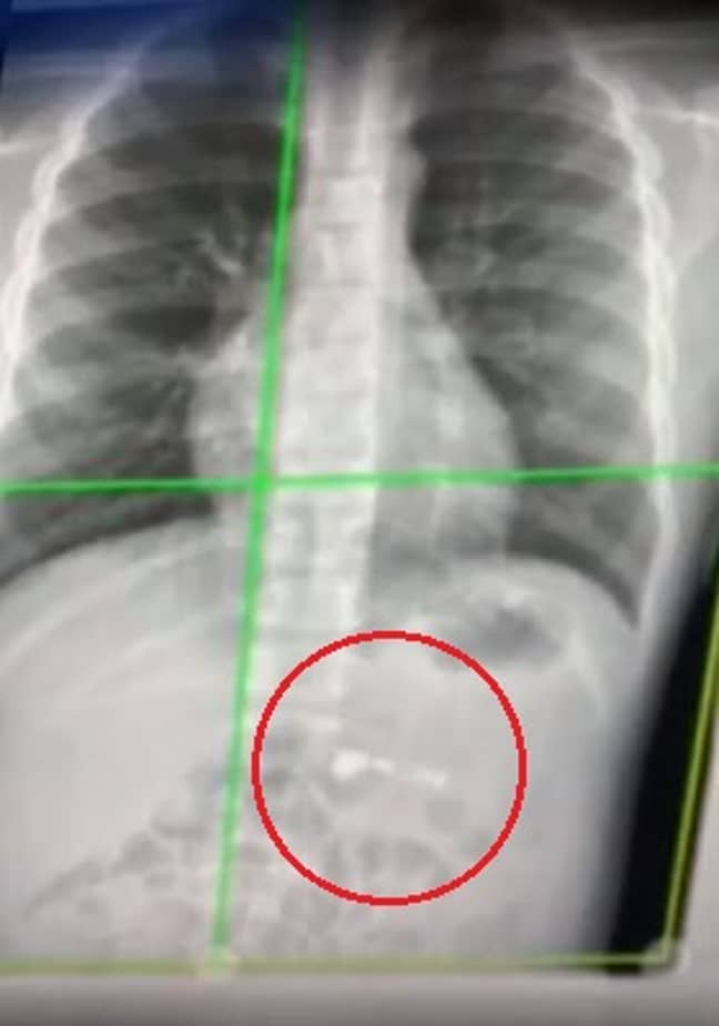 X射线显示了他的肋骨笼子下面的空脚架。学分：WSB-TV2